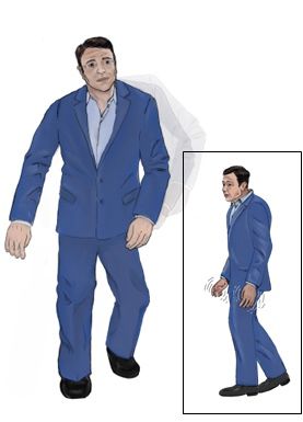 C. 중간 단계 파킨슨병