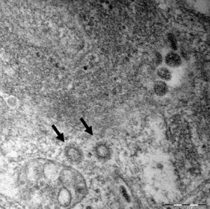 환자에게서 얻은 코로나19 바이러스 표본의 고해상 전자현미경 사진