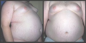 cm}}. 팽창선과 여성형 유방증이 나타난다.