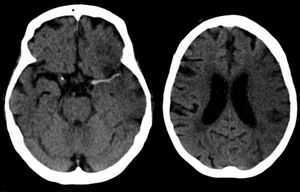 왼쪽 이미지에 나타난 중대뇌동맥(middle cerebral artery) 경색 환자의 고밀도 동맥 징후(Dense artery sign). 오른쪽 이미지는 7시간 후 촬영된 사진.