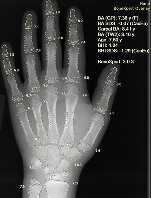 X-ray of a hand with calculation of bone age analysis