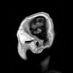 양성 가족성 거대뇌증 환자의 두부 측면 MRI.