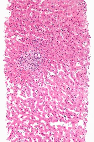 약물로 인한 간염