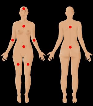 총 9곳(머리, 팔, 가슴, 복부, 등 상부, 등 하부, 다리) 중 6곳 이상에서 3개월 이상 지속되는 다발성 통증으로 정의
