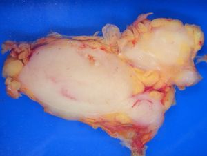 소포 림프종이 림프절을 대체하는 모습. 거품 모양의 돌기는 비대해진 소포를 나타낸다.