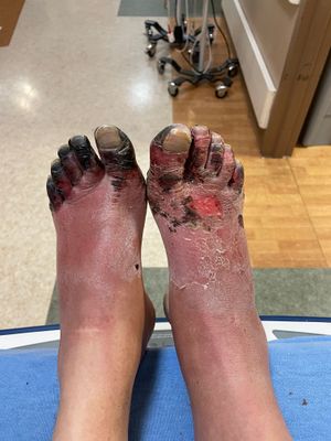 동상 환경에서 5일 후 노숙 환자의 4도 동상. 환자는 참호족(trench foot)이 발생하여 발을 제대로 말릴 수 없었습니다.