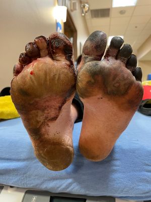 동상 환경에서 5일 후 동상에 걸린 발의 발바닥. 환자는 신발이 부적절한 노숙자였습니다.