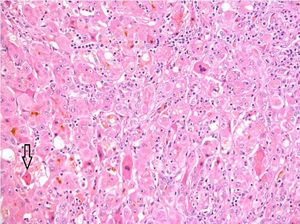 급성 간염의 조직병리학적 소견: 소엽 배열 이상과 관련 림프구 염증, 산호성 소체 형성(화살표) 및 담즙 정체