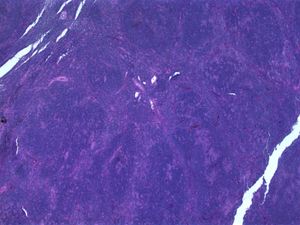 외투세포 림프종이 있는 림프절(저배율, H&E)