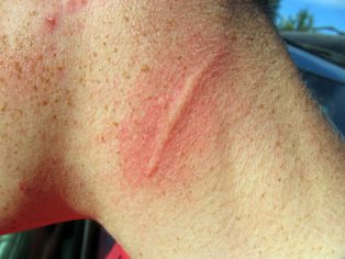 기계적 자극에 의한 물리적 두드러기