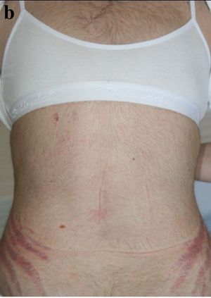 의원성 쿠싱 증후군을 앓고 있는 30세 여성 환자의 다모증과 팽창선