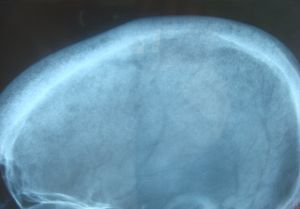 고칼슘혈증의 고전적인 X선 사진 모습, 후추와 소금 모양