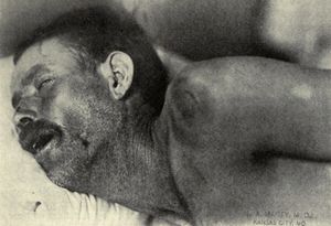 1911~1912년 텍사스 수막염 유행 당시 목 경직