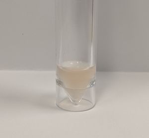 척수막염 환자의 혼탁한 뇌척수액(Streptococcus균에 의한 척수막염)