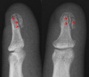 망치로 손가락 끝을 치면 분쇄(다중 파편) 손가락 골절이 발생할 수 있습니다.