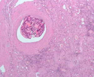 색전술 시술로 인한 혈관 내 이물질