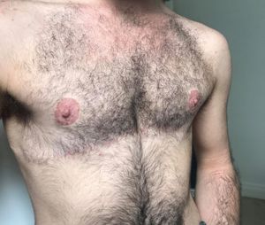 양측 유방 절제술을 통해 남성화된 가슴을 가진 트랜스젠더 남성