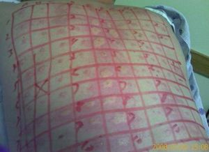 등의 피부 검사