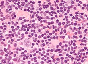 결절성 림프구 우세형 호지킨 림프종에서 관찰되는 리드-슈테른베르크 세포 변이체인 "팝콘 세포". H&E 염색