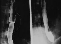조영제로서 식도를 조영한 X선 사진