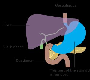 위암 절제를 위한 Roux-en-Y 수술 전 해부학
