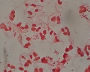 임균과 요도 분비물에서 발견되는 고름 세포 (그람 염색)