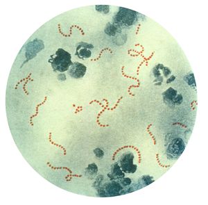 Streptococcus pyogenes 박테리아 (Pappenheim 염색), 류마티스열의 유발 요인