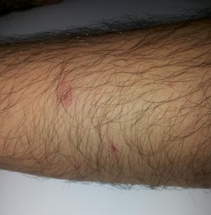 98% 황산 두 방울이 튄 후 발생한 얕은 화학 화상(팔뚝 피부)