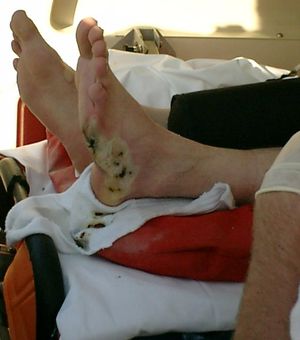 고압선 사고 후 2도 화상