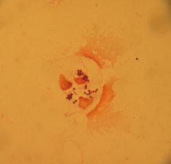 가래 샘플에서 그람 염색으로 확인한 전형적인 그람 양성 구균(cluster 형태)