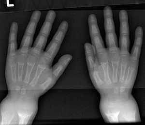 구루병을 보여주는 손목 엑스레이 사진. 주로 컵 모양 변형이 보임.