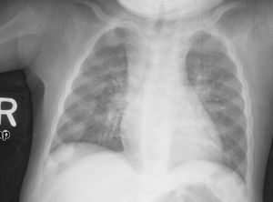 구루병과 일치하는 변화를 보여주는 흉부 엑스레이 사진. 이러한 변화는 일반적으로 구루병의 "염주 모양"이라고 함.