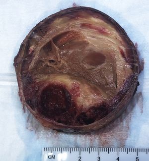 동맥류의 단면. 대부분의 영역이 조직화된 벽내 혈전(갈색 부분)으로 구성되어 있음