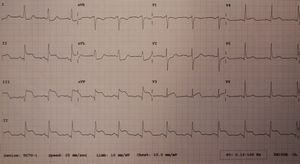 우심실 심근경색(STEMI)을 보여주는 12-유도 심전도. 오른쪽 관상동맥의 관류 감소로 인해 나타남. II, III, aVF 유도에서 ST분절의 상승이 관찰됨.