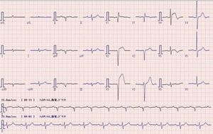 V2-4에서 ST 상승을 보이는 급성 심근경색(AMI)의 심전도