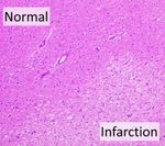 저배율 조직병리학에서 부종으로 인한 경색 부위의 창백함을 보이는 뇌경색의 모습(H&E 염색).