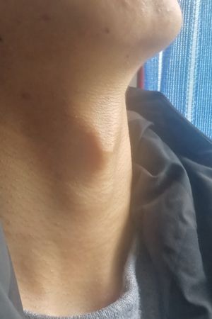 20대 남성의 후두융기. 위는 갑상연골, 아래는 윤상연골이다.