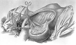 근치 유방 절제술