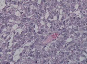 난황낭 종양에서 보이는 쉴러-듀발 소체