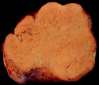 크루켄베르크 종양. CEA 수치가 높은 경우가 많다. 원발병소의 정밀 검사로 내시경 검사나 PET 검사가 시행될 수 있다.