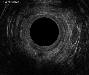 하부 항문관의 간문괄약근 사이 누공. 누공이 F로 표시된 초음파 영상.