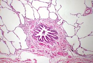 세기관지 주변으로 매우 얇게 퍼져 있는 폐포의 단층편평상피