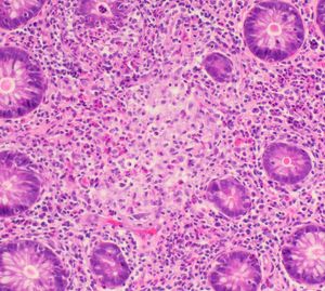 크론병으로 인한 과립종의 조직 염색.