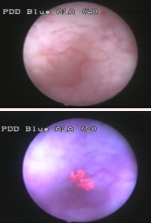 청색광 방광경 검사에서 보이는 방광 종양(아래 이미지, 분홍색), 일반 백색광 방광경 검사에서는 보이지 않음