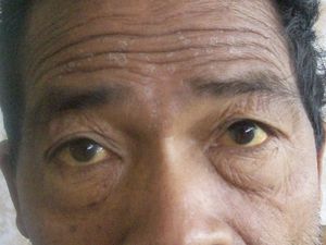 피부(황달)와 눈(공막)이 노랗게 변하는 증상.