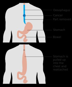 식도 절제술 전과 후
