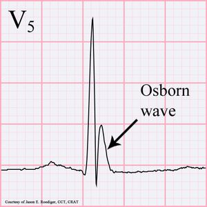고칼슘혈증과 관련될 수 있는 비정상적인 심전도(ECG) 추적, 오스본 파형