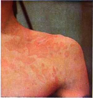 어깨 부위 지루성 피부염