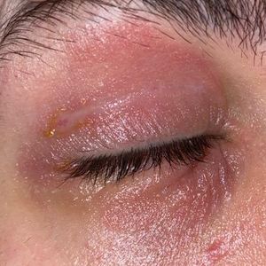 눈꺼풀 지루성 피부염