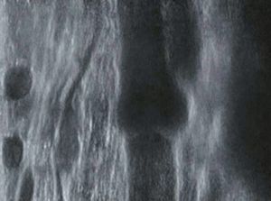 슬와정맥 내 판막 영상